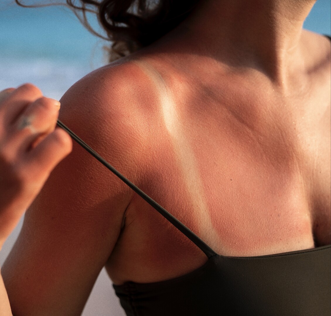 Cuidado de la Piel Después de las Vacaciones